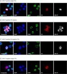 AR-V7 Expression in Circulating Tumor Cells and Castration-Resistant Prostate Cancer Outcomes | from Flow Cytometry to Cytomics | Scoop.it