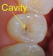 How I Healed My Child’s Cavity | Health Supreme | Scoop.it
