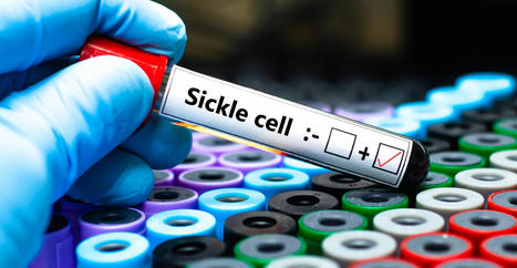 Sickle cell disease gene therapies Casgevy Lyfgenia insurance cost issues | Immunology and Biotherapies | Scoop.it