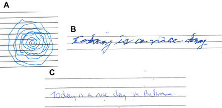 Does This Patient Have Parkinson Disease or Essential Tremor? | interRAI | Scoop.it
