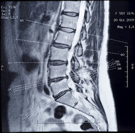 Chronique de la douleur: L'IRM chez le lombalgique : c'est pas automatique (saison 1, épisode 1) | L'arthrose | Scoop.it