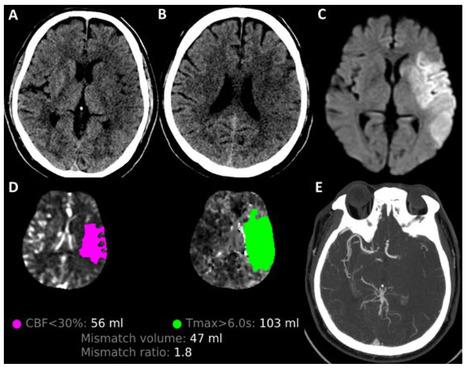 Revolutionizing the Management of Large-Core Ischaemic Strokes: Decoding the Success of Endovascular Therapy in the Recent Stroke Trials | Neurovascular Intervention | Scoop.it