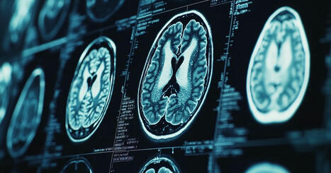 Cómo funciona la inteligencia artificial que puede detectar Alzheimer y otras demencias con una sola imagen | Alzheimer y más (Boletín nº 69) | Scoop.it