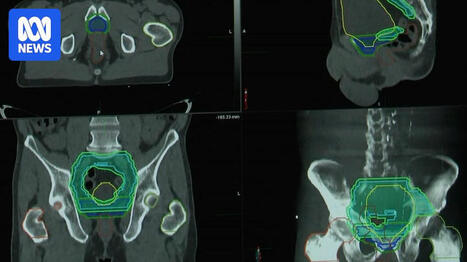 Psychological side effects for common prostate cancer treatment raise concerns. | Hospitals and Healthcare | Scoop.it