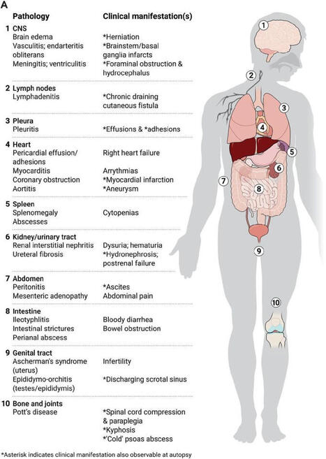 TB Immunopathogenesis and Immune Response | Science Magazine posted on the topic | Immunology | Scoop.it