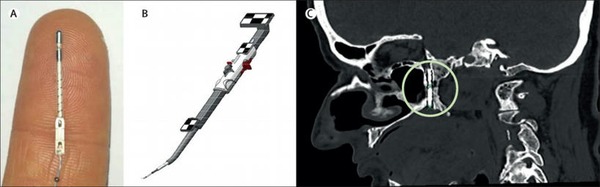 An injectable implant to stimulate the sphenopalatine ganglion for treatment of acute ischaemic stroke up to 24 h from onset (ImpACT-24B) | Neurovascular Intervention | Scoop.it