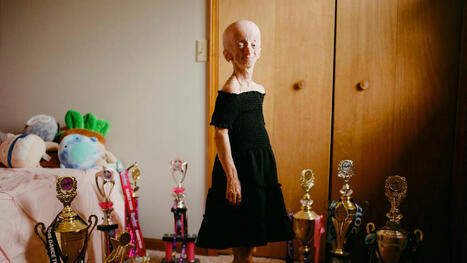 The Quest to Cure Progeria Is a Quest to Slow Aging | by  Dhruv Khullar | NewYorker.com | Schools + Libraries + Museums + STEAM + Digital Media Literacy + Cyber Arts + Connected to Fiber Networks | Scoop.it