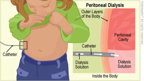 Peritoneal Dialysis (for Parents) | Peritoneal dialysis | Scoop.it