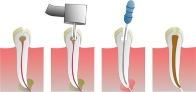 What is A Root Canal? | Medical and Health | Scoop.it